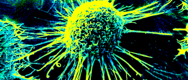 cancer vaccine