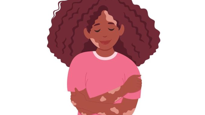 Vitiligo-1