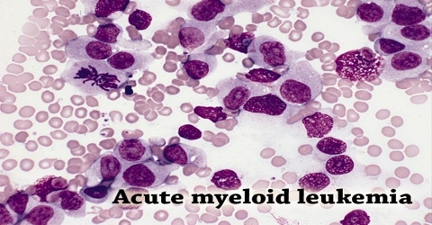 Acute-Myeloid-Leukemia