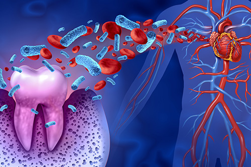 Tooth Decay Disease