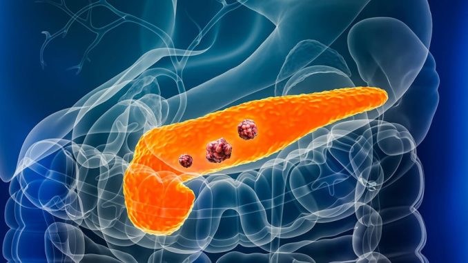 pancreatic-cancer